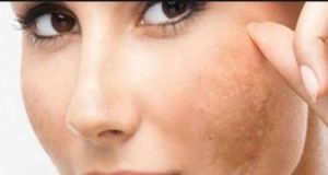 5 إسعافات أولية للنساء حال الإصابة بحرقة الوجه بسبب أشعة الشمس